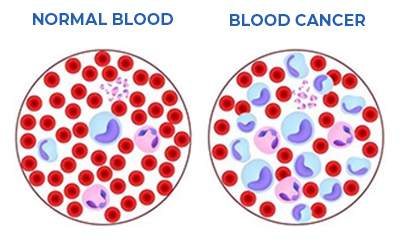 Blood Cancer