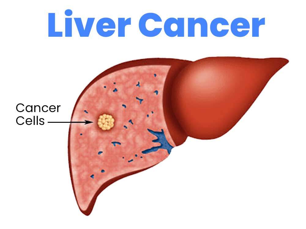 liver-cancer--jpg
